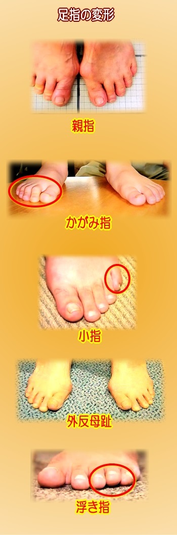 足指の圧力分布